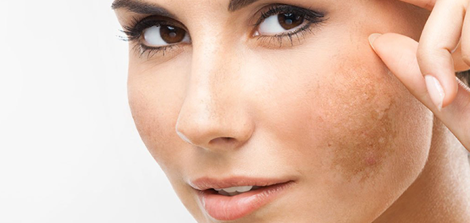 Güneş Lekesi Nasıl Geçer