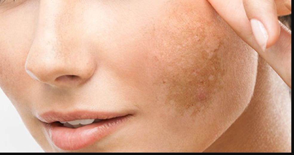 Ciltteki Kahverengi Lekeler Nasıl Geçer