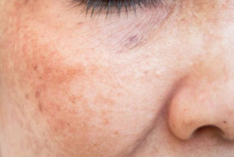 Güneş Yanığı İzi En Hızlı Nasıl Geçer