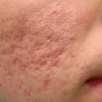 Sivilce Lekesi Nasıl Geçer https://detaybilgi.com/