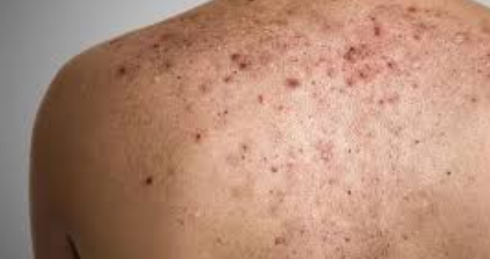 Sivilce Lekesini En Hızlı Ne Geçirir