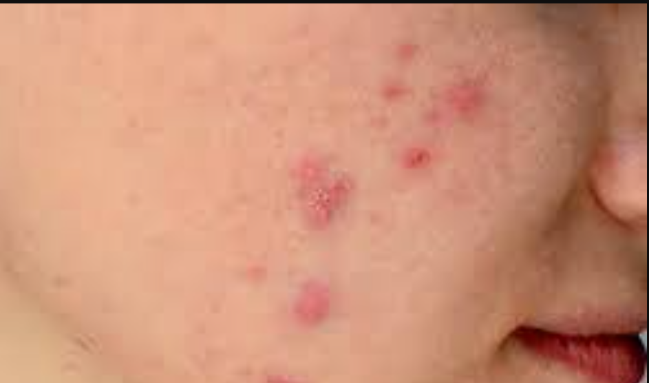 yuzdeki-sivilce-izlerini-ne-yok-eder-162713