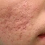 Sivilce Lekesi Nasıl Geçer https://detaybilgi.com/