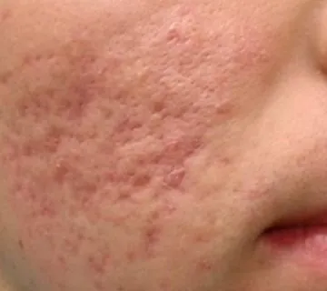 Sivilce Lekesi Nasıl Geçer https://detaybilgi.com/