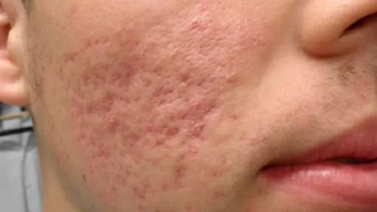 Sivilce Lekesi Nasıl Geçer https://detaybilgi.com/