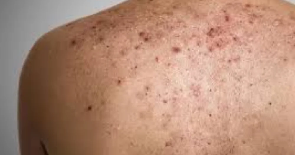 Sivilce Lekesini En Hızlı Ne Geçirir